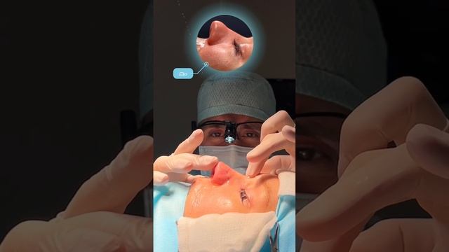 Первичная риносептопластика на операционном столе 👃🏼
