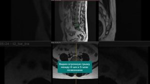 История лечения межпозвонковой грыжи
