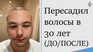 Пересадил волосы в 30 лет (Сравнение ДО и ПОСЛЕ)