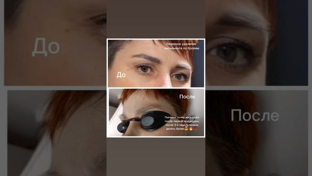 Лазерное удаление бровей