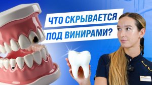 Ужасная ПРАВДА о винирах | Кариес под винирами