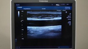 Canon (Toshiba) Aplio 500 обзор ультразвукового сканера