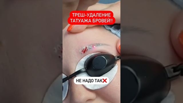 ⭐️Блог про удаление ПМ и тату! Подписывайся! #лазерноеудалениетату #перманентныймакияж #татуаж