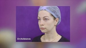 Скелетизация костных краев глазницы. Что делать? Как восстановить молодые контуры лица.