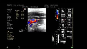 УЗИ сонных артерий. Атеросклероз. Бляшка в позвоночной артерии ввела меня в ступор:).