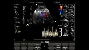 УЗИ сосудов почек (дуплексное сканирование, УЗДГ почечных артерий