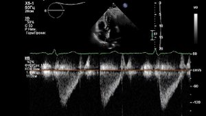 УЗИ сердца. Окклюдер ДМПП в 60 лет