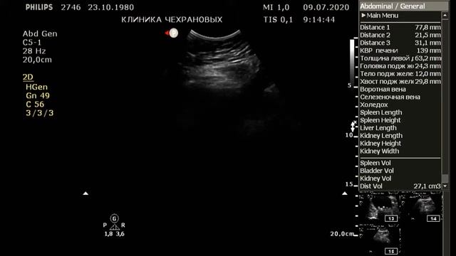 УЗИ органов брюшной полости и почек,   терапевт Докучаева , клиника Чехрановых,  2020 07 09 09 05 11
