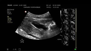УЗИ органов брюшной полости. Желчекаменная болезнь! Сладж и камни желчного пузыря в 26 лет!