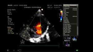 УЗИ СЕРДЦА РЕБЕНКУ (1-2 МЕС)