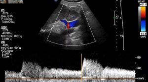 УЗИ сосудов почек.