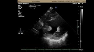 Тяжелый аортальный стеноз