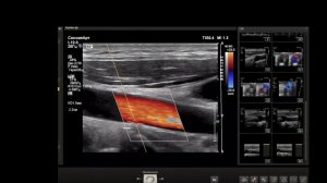 УЗИ сосудов шеи (БЦА). Расхождение диагноза?