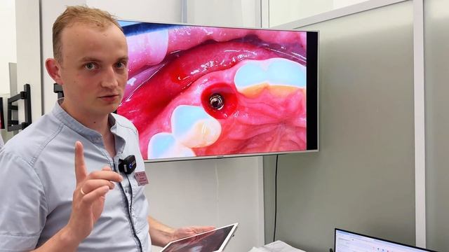 Десневой сосочек. Как нарастить десну.