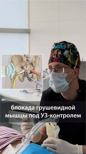 Блокада грушевидной мышцы с ультразвуковой навигацией