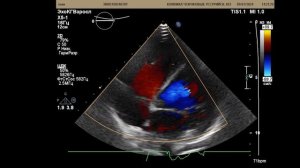 Врожденный порок сердца в 22 года: Коарктация аорты...