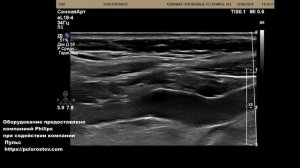 УЗИ сонных артерий. Самая частая находка ?