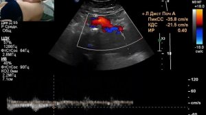 УЗИ сосудов почек. Сморщенная правая почка. Стеноз левой почечной артерии