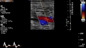 УЗИ артерий нижних конечностей. Жалобы на слабость в ногах. Есть ли нарушения гемодинамики?