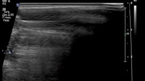 УЗИ щитовидной железы по протоколу. Аппарат Epiq7 , датчик 18 Mhz