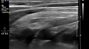 УЗИ сонных артерий. Есть ли атеросклероз у женщины в 44  года?