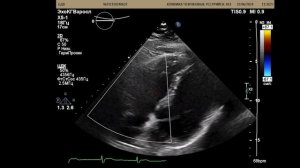 УЗИ сердца 44 года.  Пока все нормально...