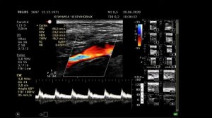 УЗИ БЦА УССУРИЙСК КЛИНИКА ЧЕХРАНОВЫХ 2020 06 30 10 30 39