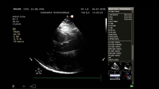 УЗИ сонных артерий  УЗИ экстракраниальных брахиоцефальных артерий УЗИ сердца.