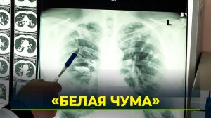 На Ямале снизилась заболеваемость туберкулёзом