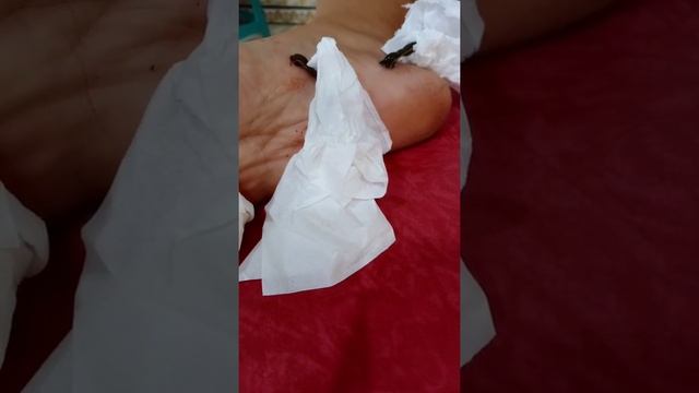 Terapi lintah Yogyakarta
