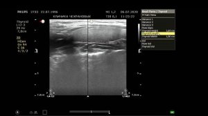 УЗИ щитовидной железы в Уссурийске. Врач УЗИ Чехранов Андрей Юрьевич,  2020 07 06 11 18 13