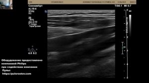 УЗИ сонных артерий  ,42 года. Есть бляшки.