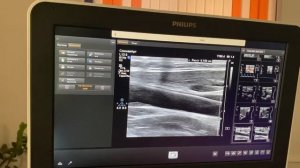 УЗИ сонных артерий. Обзор по просьбе пациента