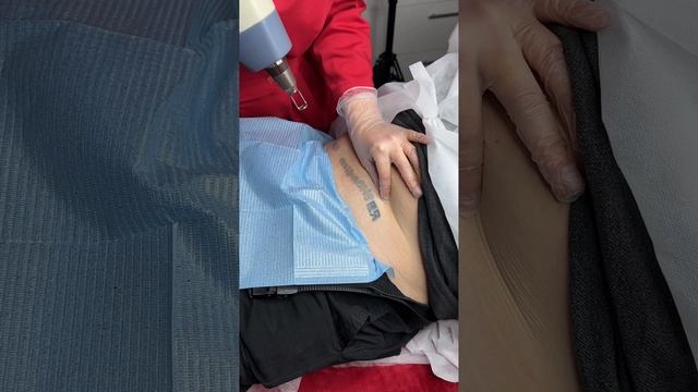 Удаление тату/Ошибка молодости смотреть онлайн