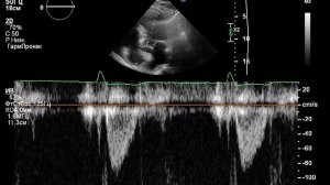 УЗИ сердца (ЭХОКГ) после двух инфарктов.