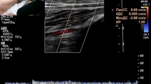 УЗИ сосудов. Определение ЛПИ ( лодыжечно-плечевой индекс)