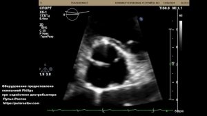 ЭХОКГ в Уссурийске. Ребенок 15 лет. Аномалия развития аортального клапана. Незначимая.