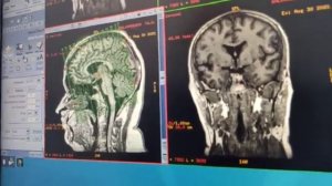 Mri reconstruction ge 15x