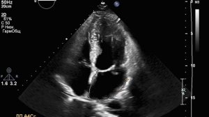 Митральный пролапс. Эксцентричная коварная митральная регургитация.