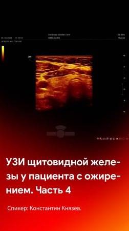 4 часть мастер-класса по сканированию щитовидной железы у пациента с ожирением