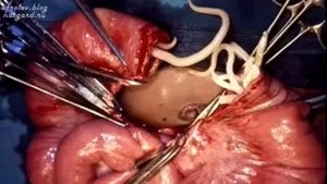 ВНИМАНИЕ➡️ все о ПАРАЗИТАХ❗ПРИЧИНА АНЕМИИ❗Почему не стоит примать дикарис , пирантел❓