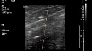 УЗИ сосудов: вены нижних конечностей