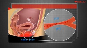 Кровообращение в области таза у женщин при сидении на стуле-седле SALLI