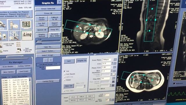Mrcp Magnetic resonance cholangiopancreatography (MRCP)