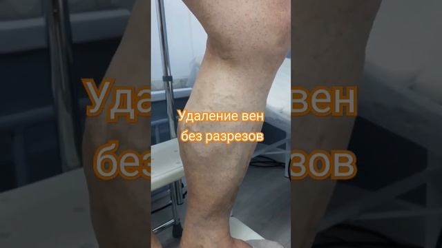 Удаление вен без разрезов. #флебологмосква #операциянавенах #варкиоз