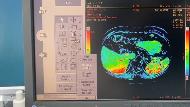 GE MRI Subtraction