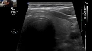 УЗИ щитовидной железы норма