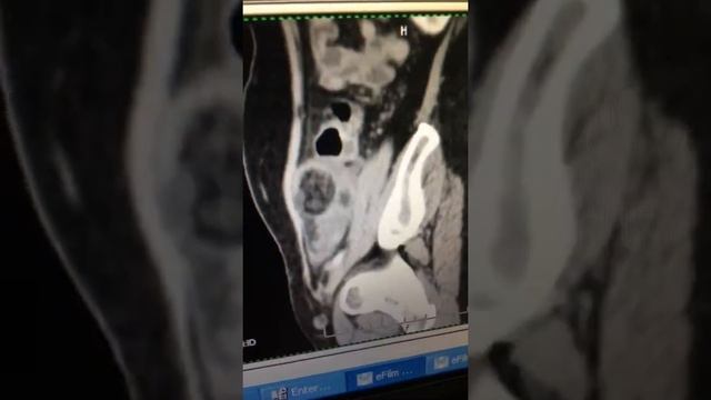 Hai khối u nghĩ teratoma trên CT bụng