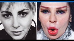 АГУЗАРОВА НАПУГАЛА ПОКЛОННИКОВ И ПОЛЬЗОВАТЕЛЕЙ СОЦСЕТЕЙ СВОИМ ВНЕШНИМ ВИДОМ ПОСЛЕ  УЖАСНОЙ ПЛАСТИКИ
