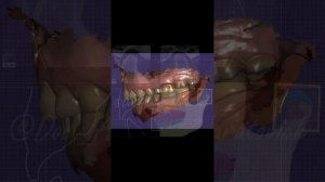 Лечение на репозиционной шине. Хрустит и щёлкает челюсть. Вправляемый вывих диска.